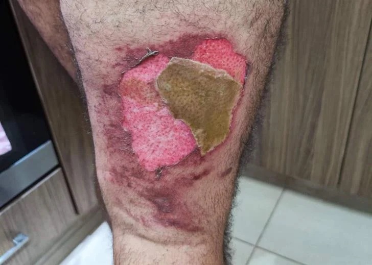 Τρόμος για 35χρονο στην Κύπρο – Πήρε φωτιά το πανάκριβο κινητό του, ενώ το είχε στην τσέπη